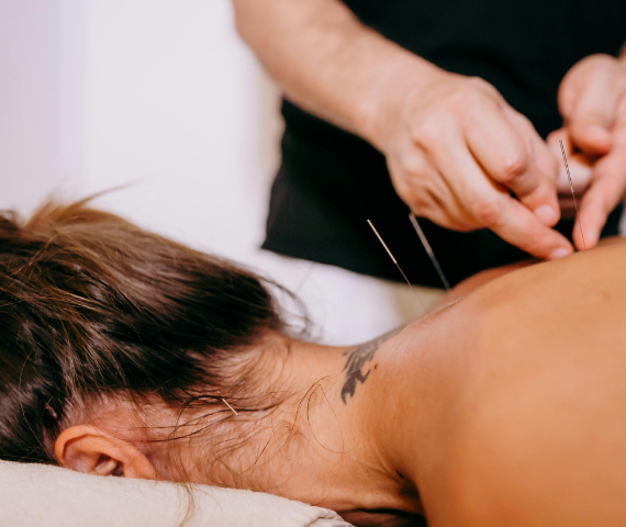 acupuncture