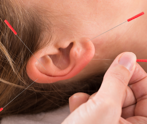 auricle acupuncture