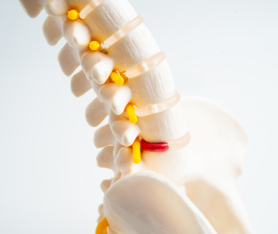 lumbar spondylosis therapy